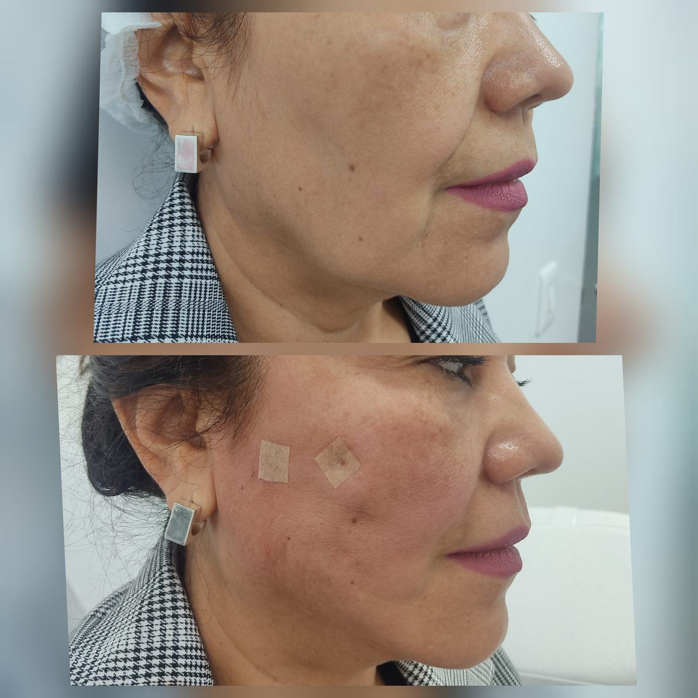 Hilos tensores (rostro) — fotografía clínica real