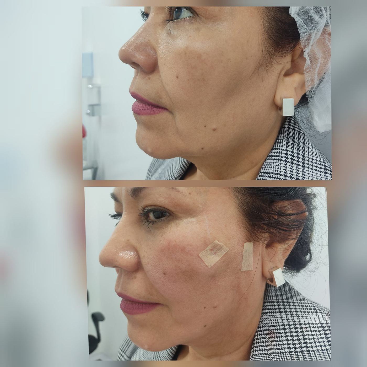 Hilos tensores (rostro) — fotografía clínica real
