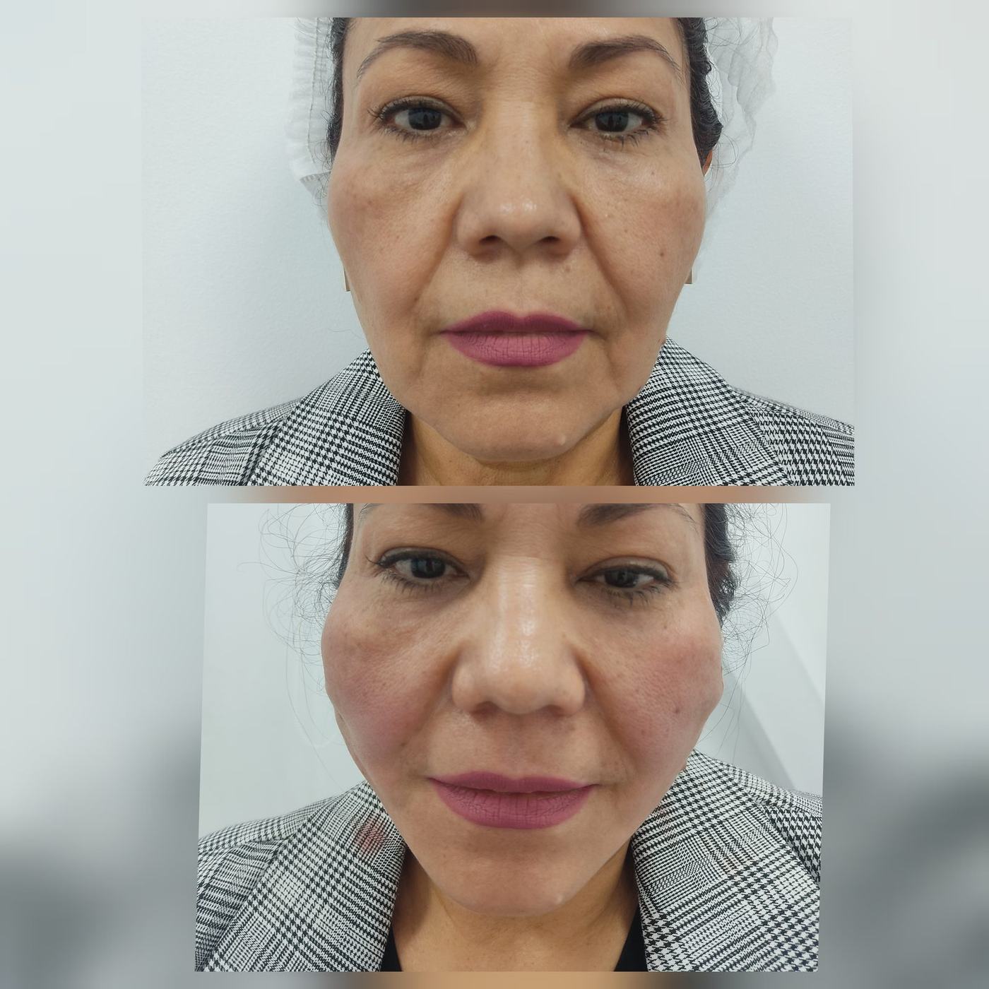 Hilos tensores (rostro) — fotografía clínica real