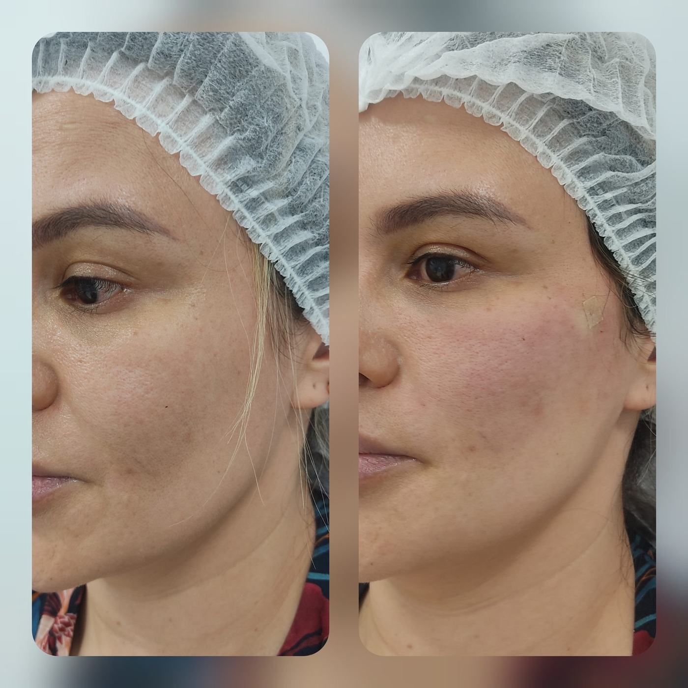 Hilos tensores (rostro) — fotografía clínica real
