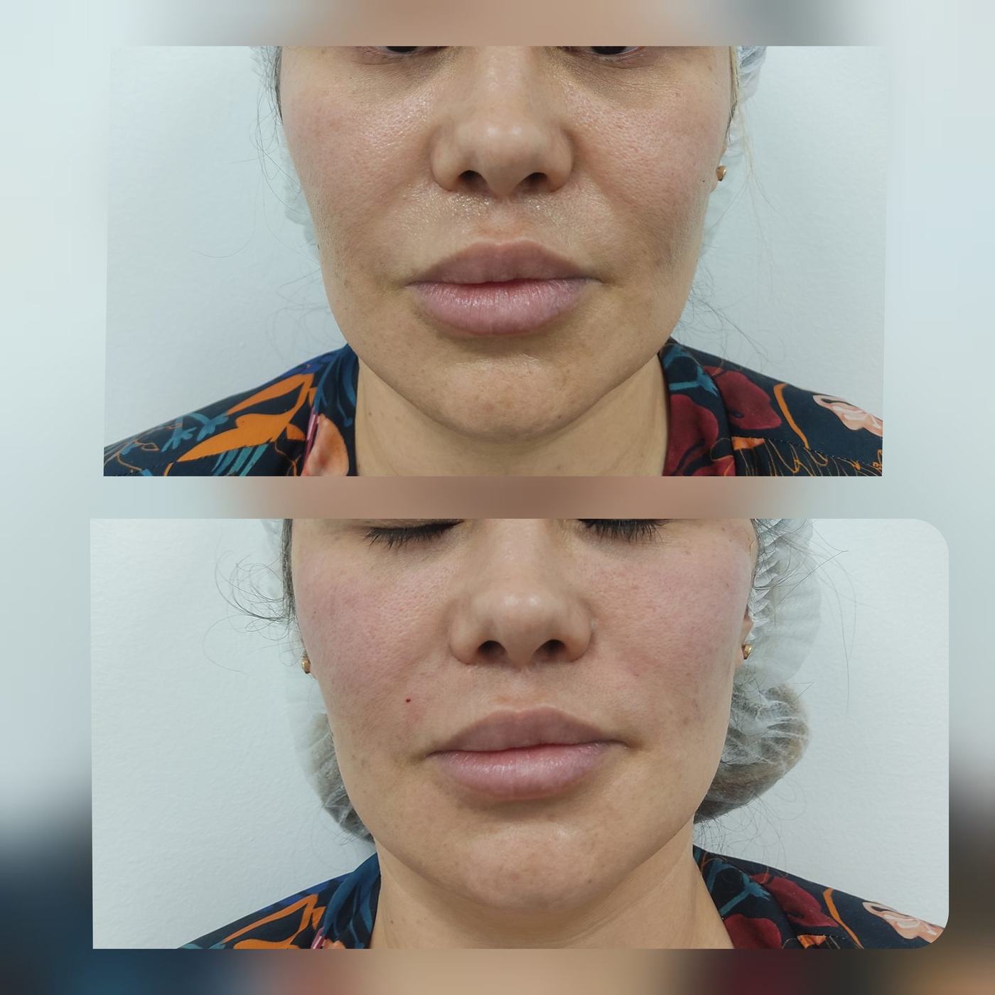 Hilos tensores (rostro) — fotografía clínica real