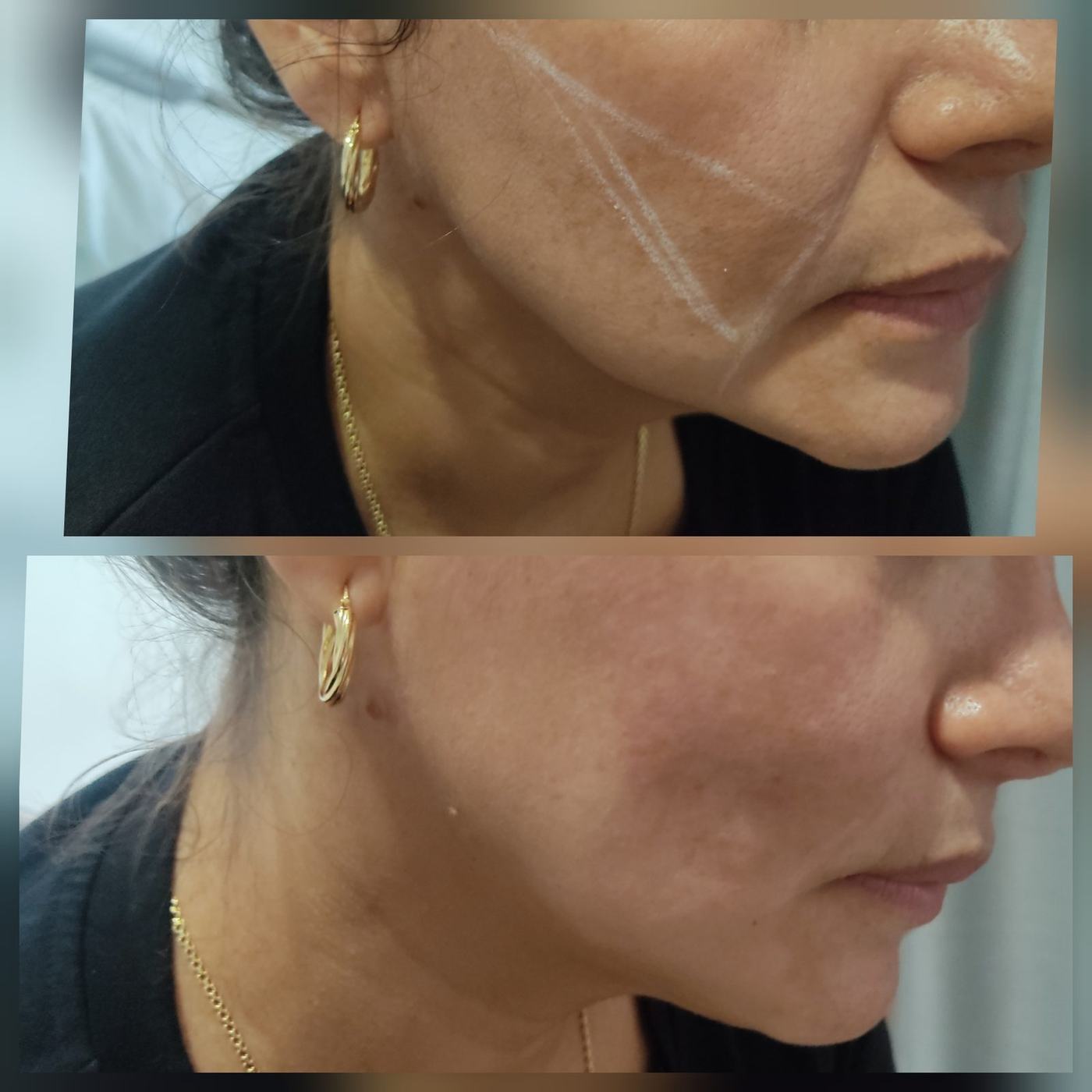 Hilos tensores (rostro) — fotografía clínica real