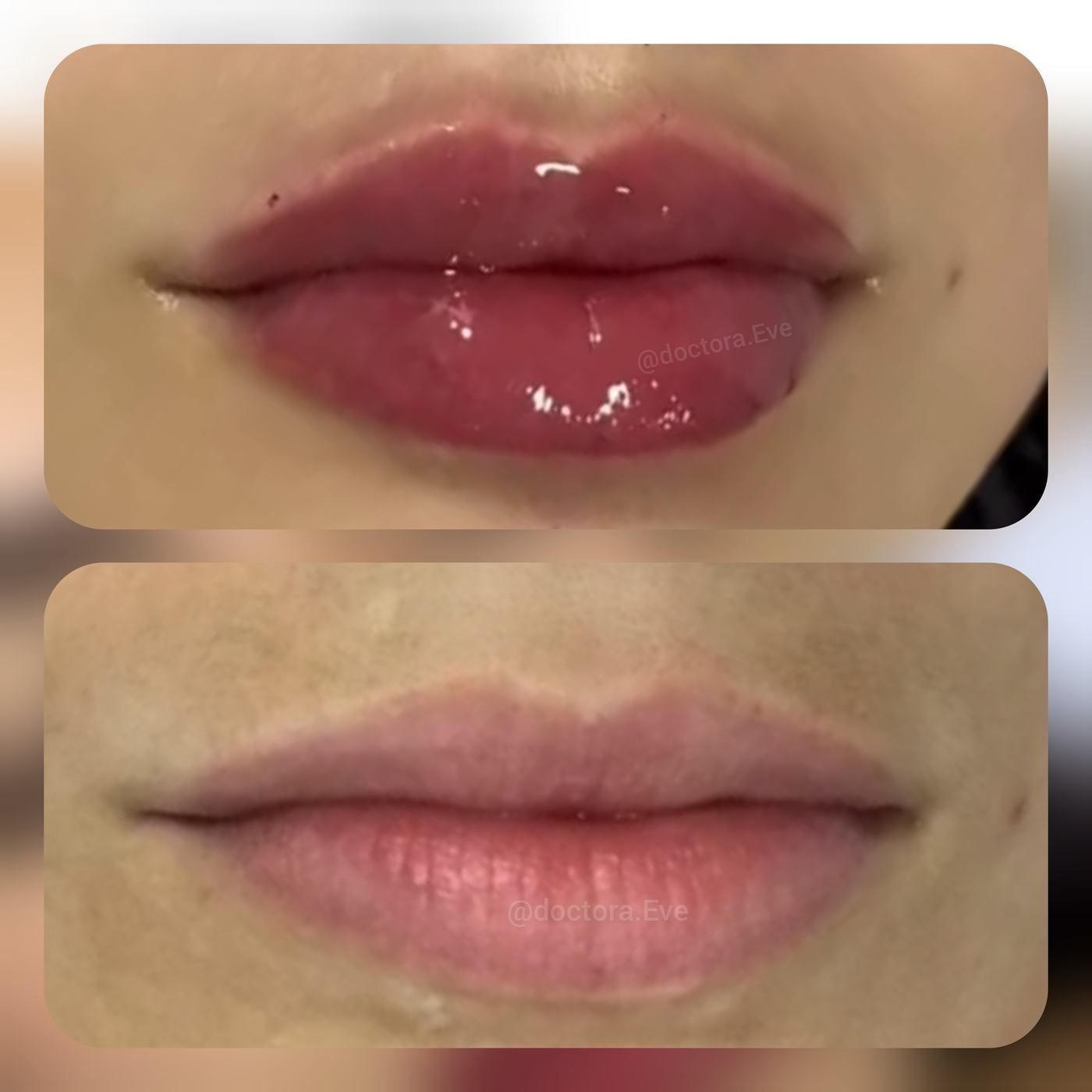 Labios — fotografía clínica real