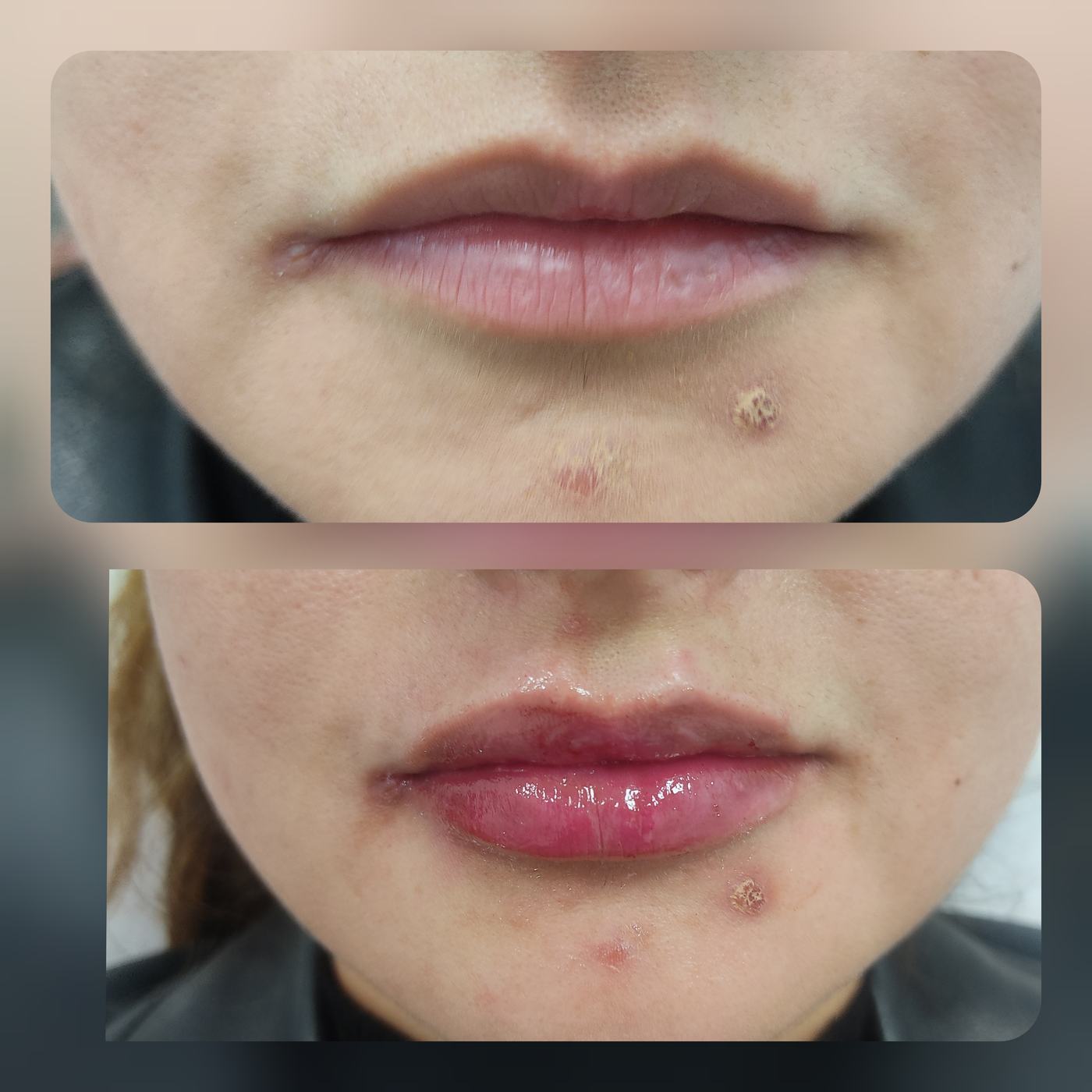 Labios — fotografía clínica real