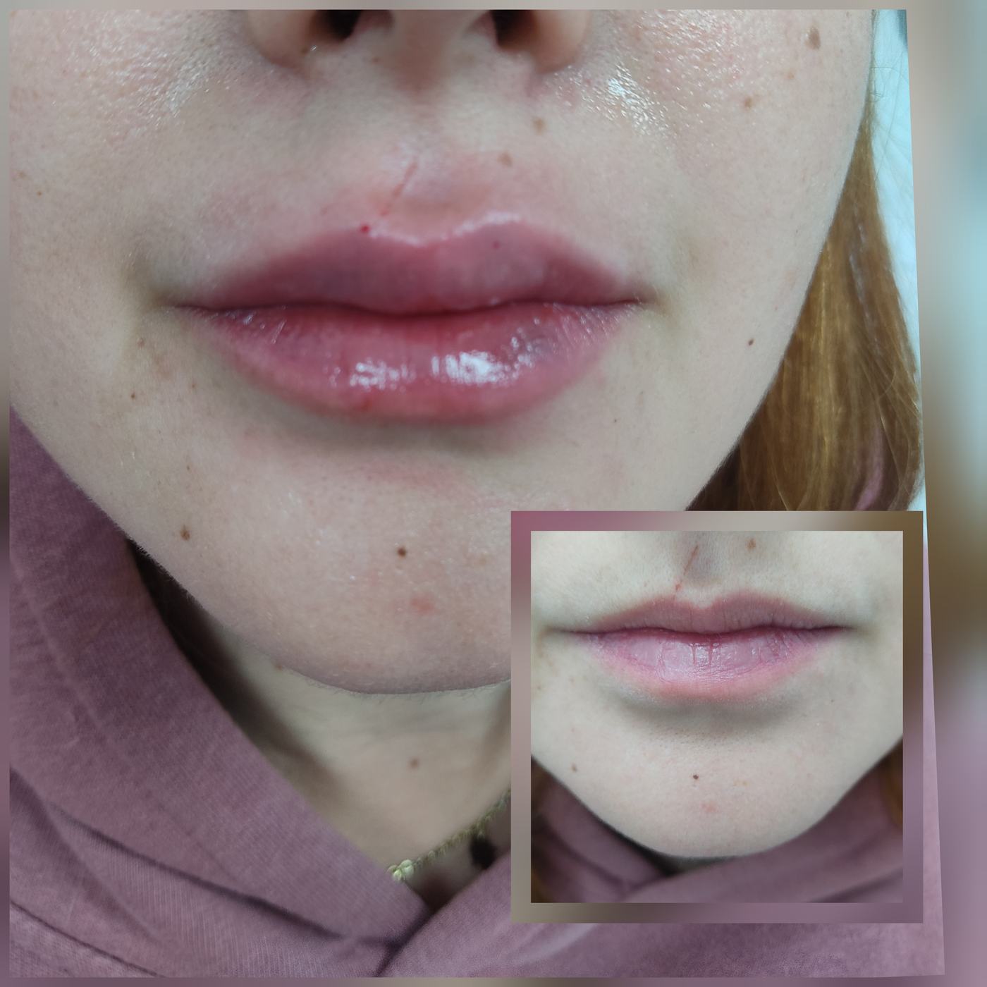 Labios — fotografía clínica real