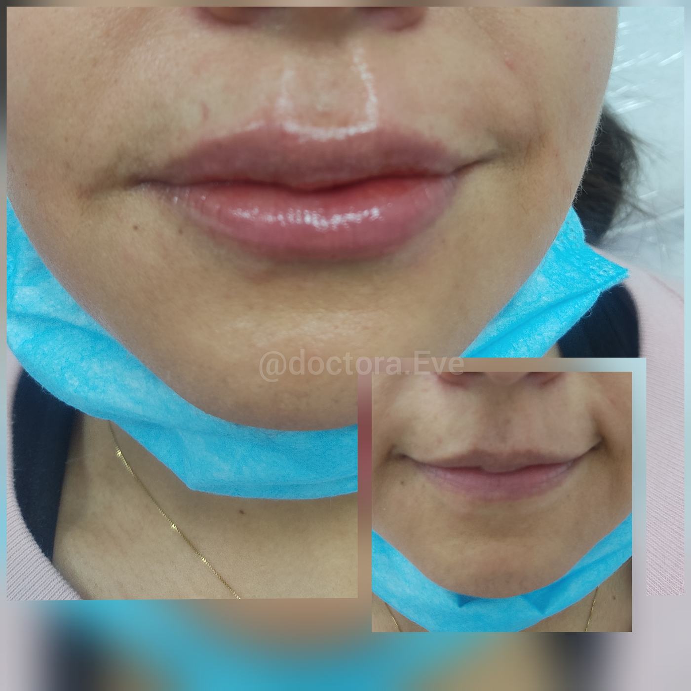 Labios — fotografía clínica real