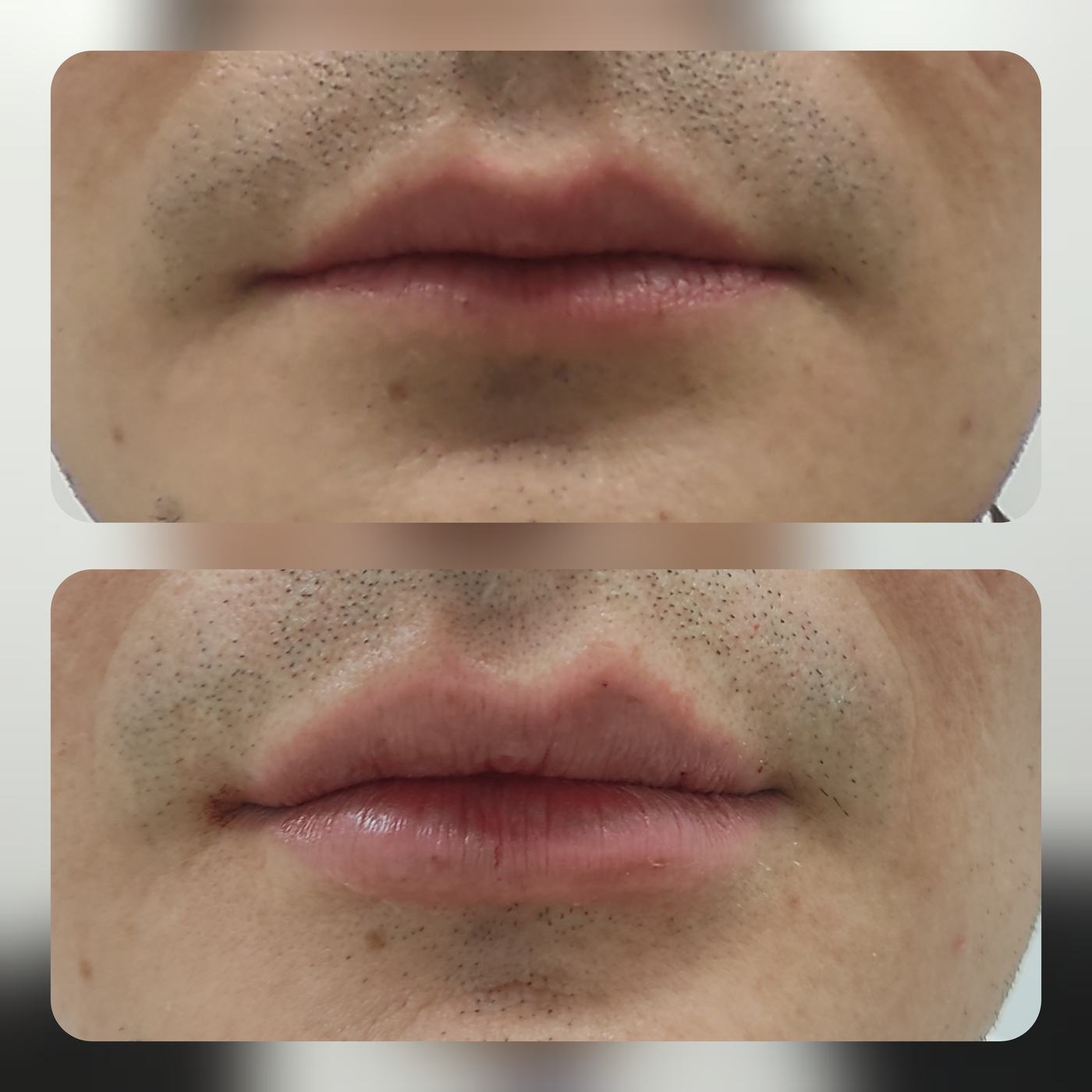 Labios — fotografía clínica real
