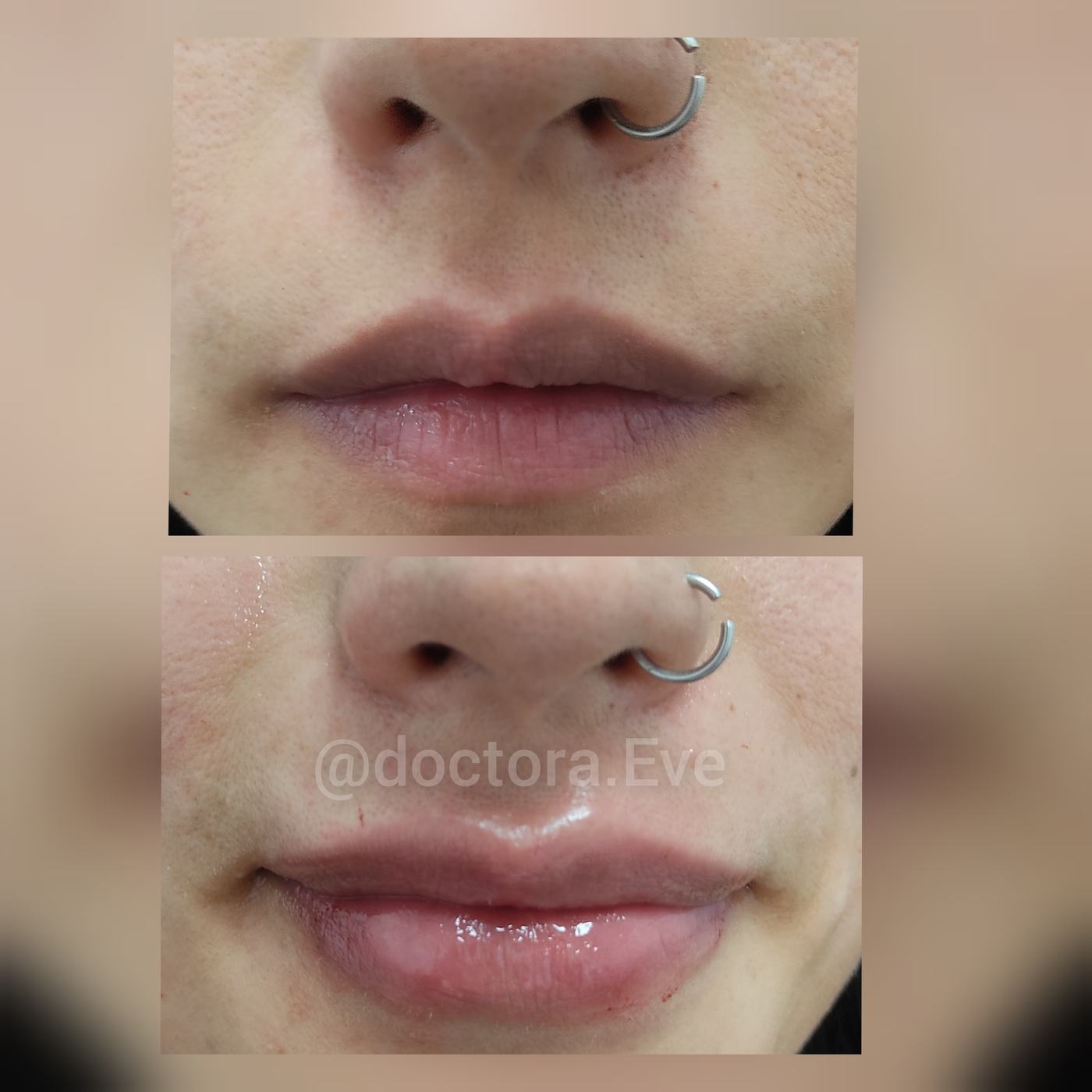 Labios — fotografía clínica real