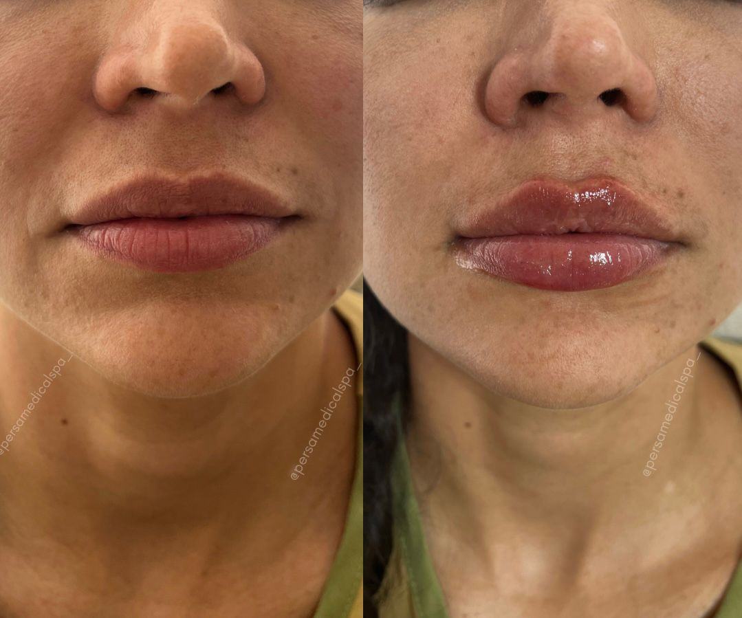 Labios — fotografía clínica real