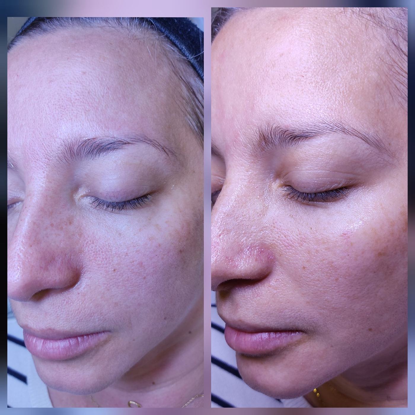 Limpieza facial — fotografía clínica real