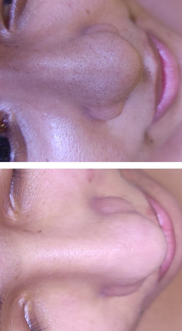 Limpieza facial — fotografía clínica real
