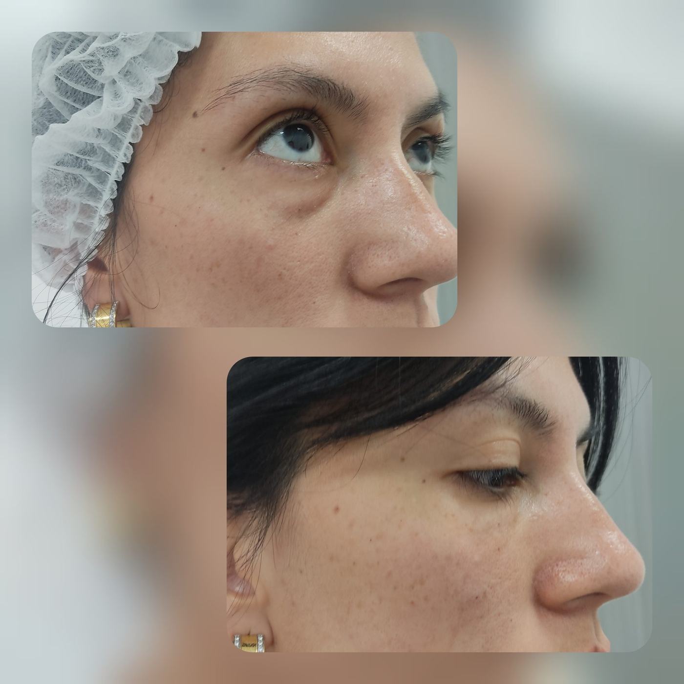 Ojeras — fotografía clínica real