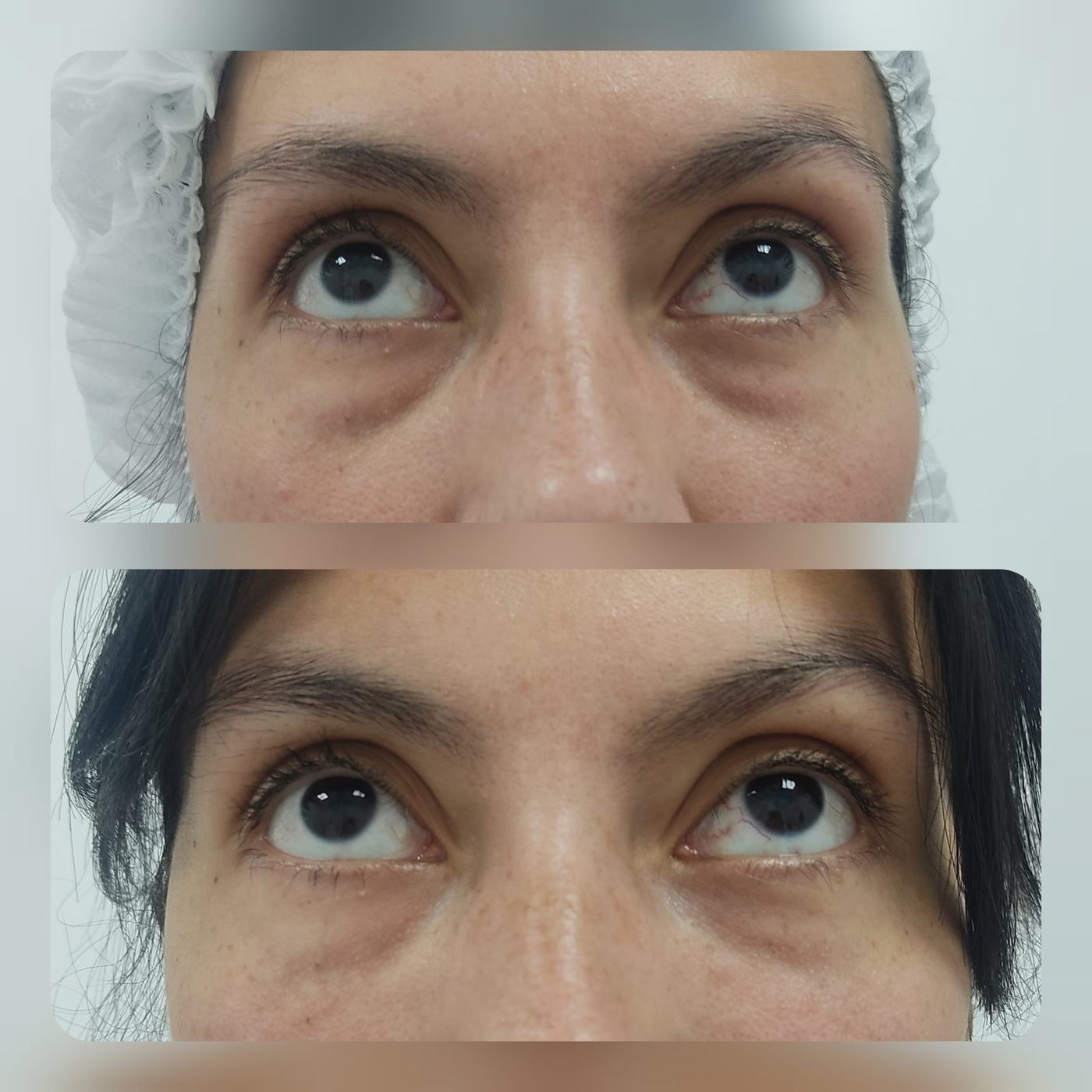 Ojeras — fotografía clínica real