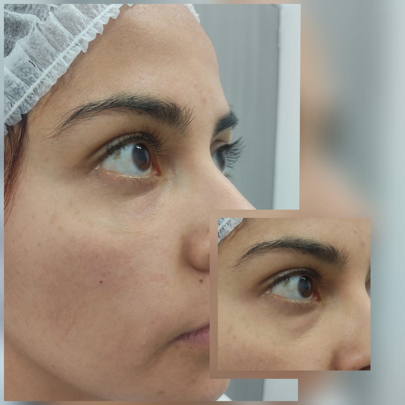 Ojeras — fotografía clínica real