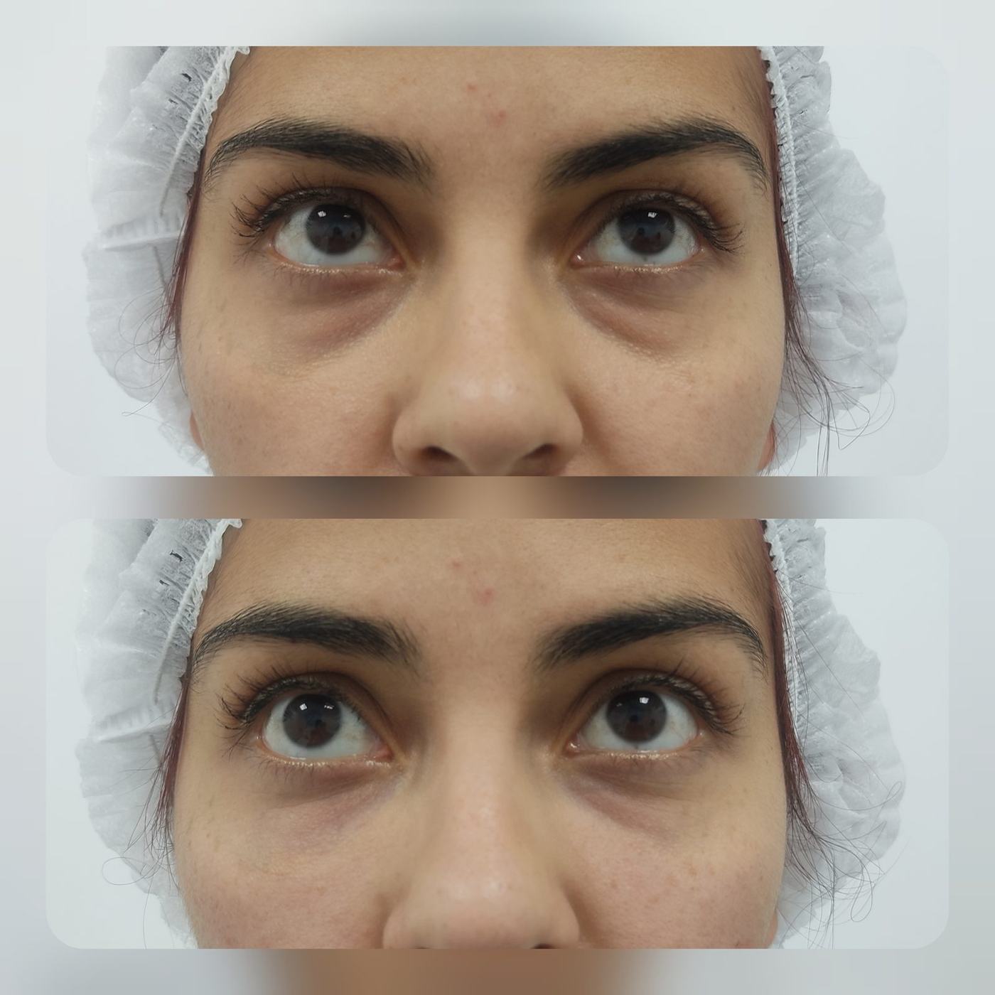 Ojeras — fotografía clínica real
