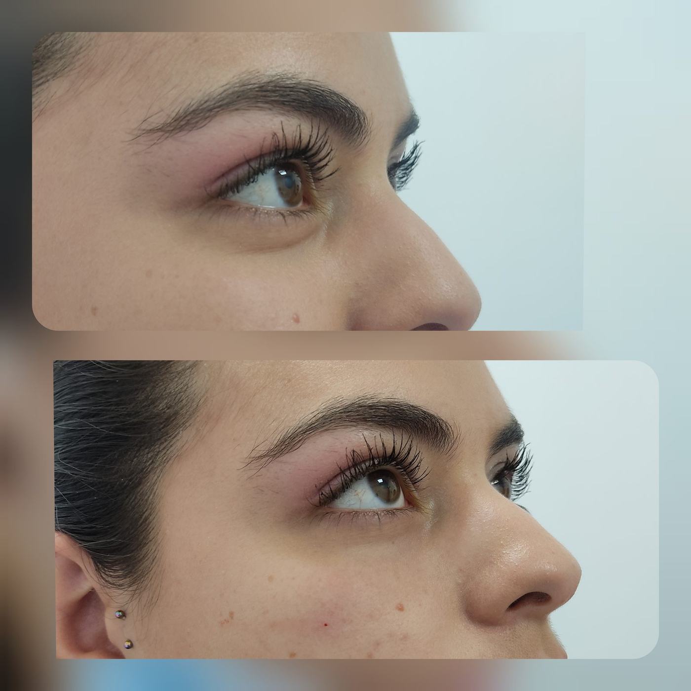 Ojeras — fotografía clínica real