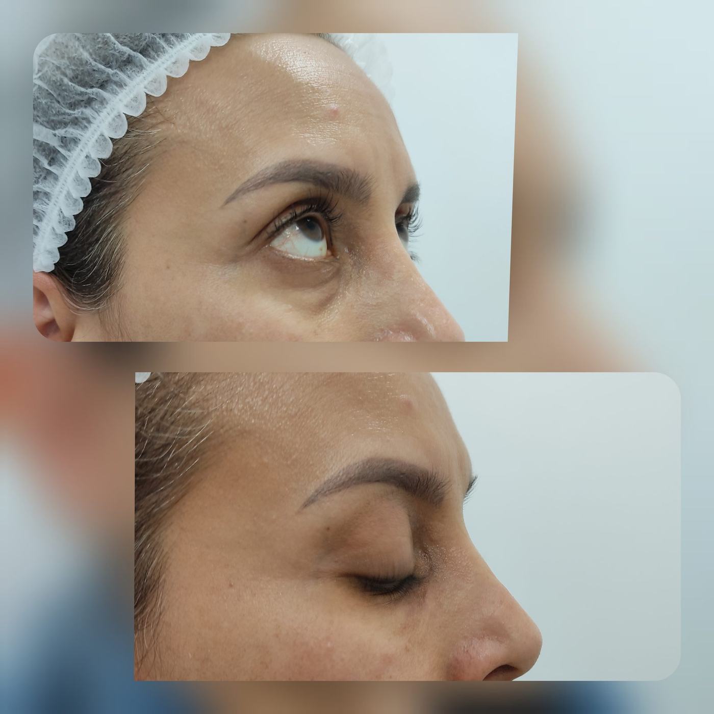 Ojeras — fotografía clínica real