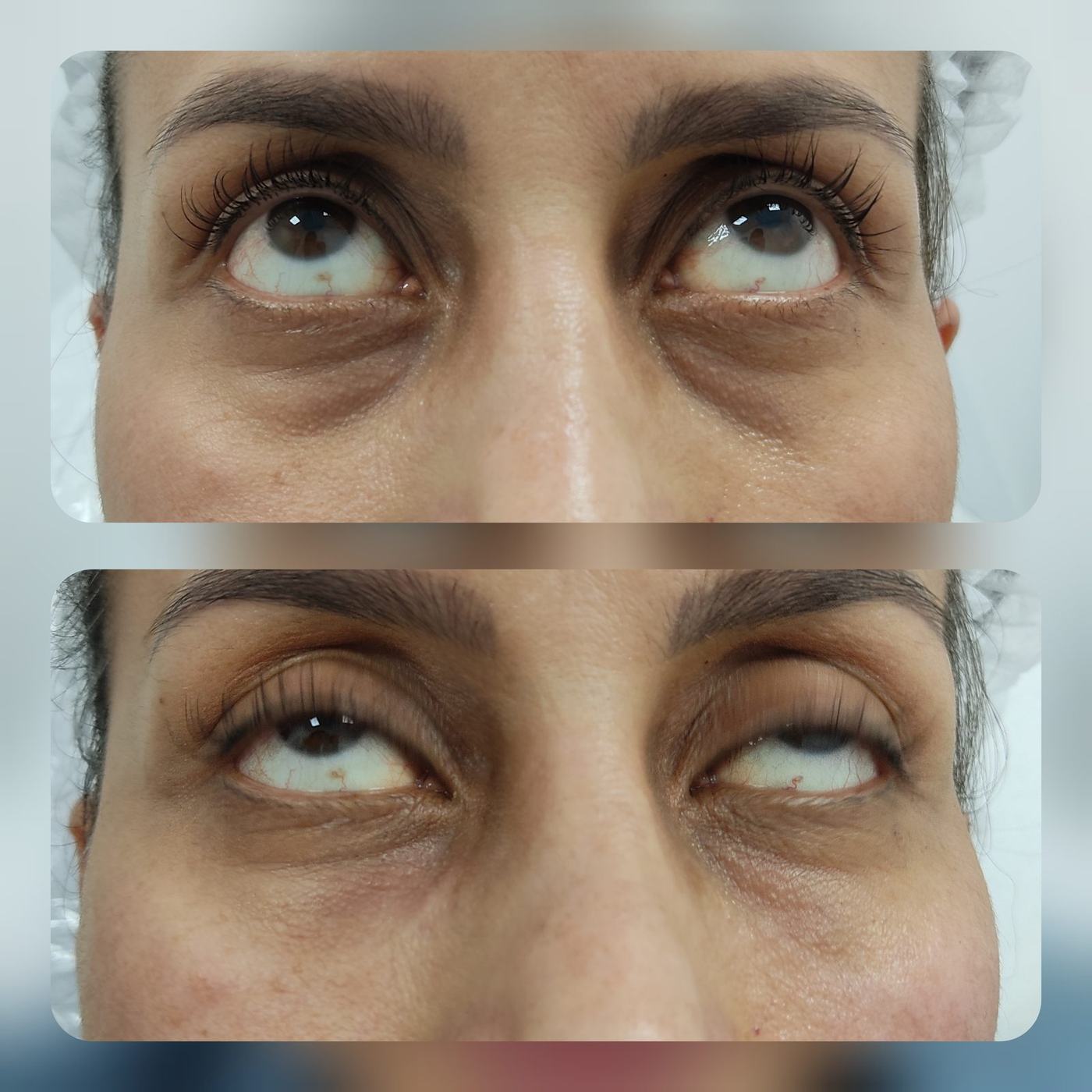 Ojeras — fotografía clínica real