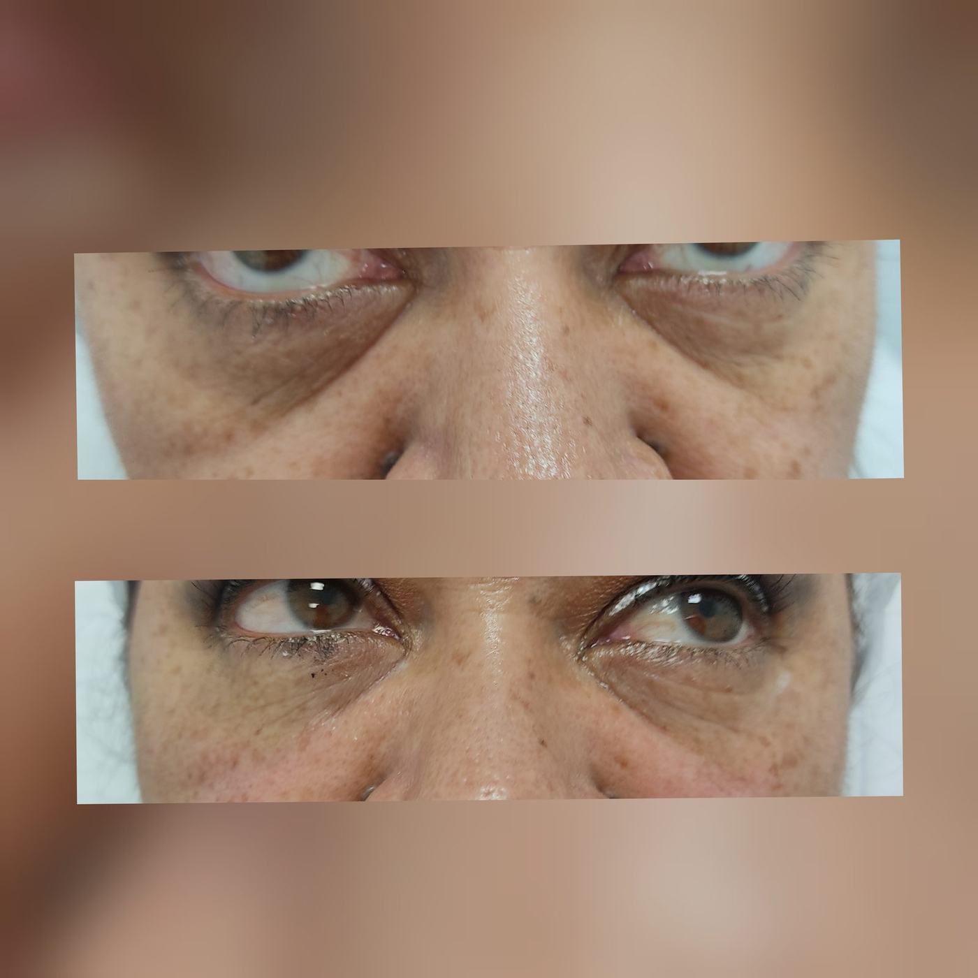 Ojeras — fotografía clínica real