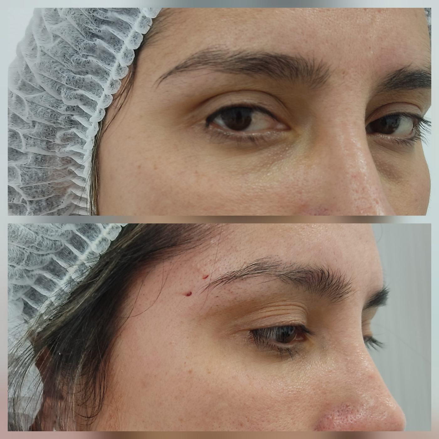Ojeras — fotografía clínica real