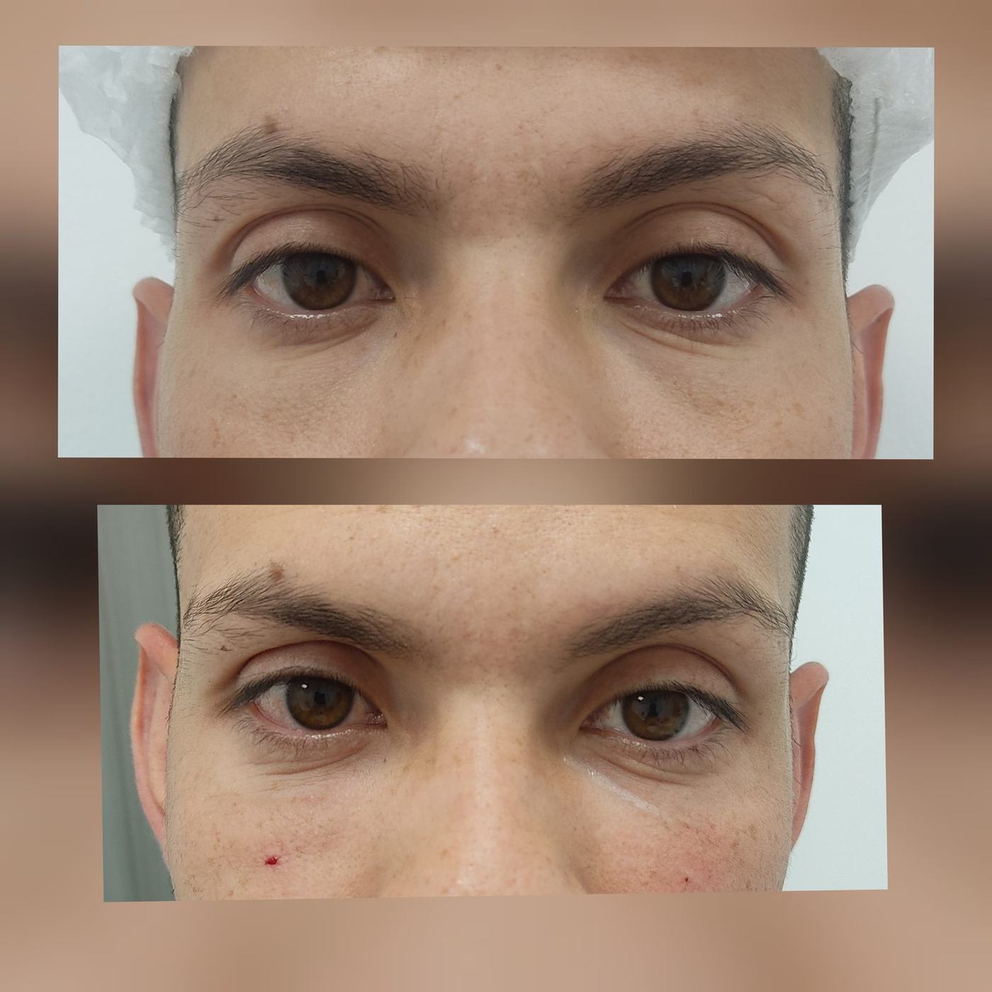 Ojeras — fotografía clínica real
