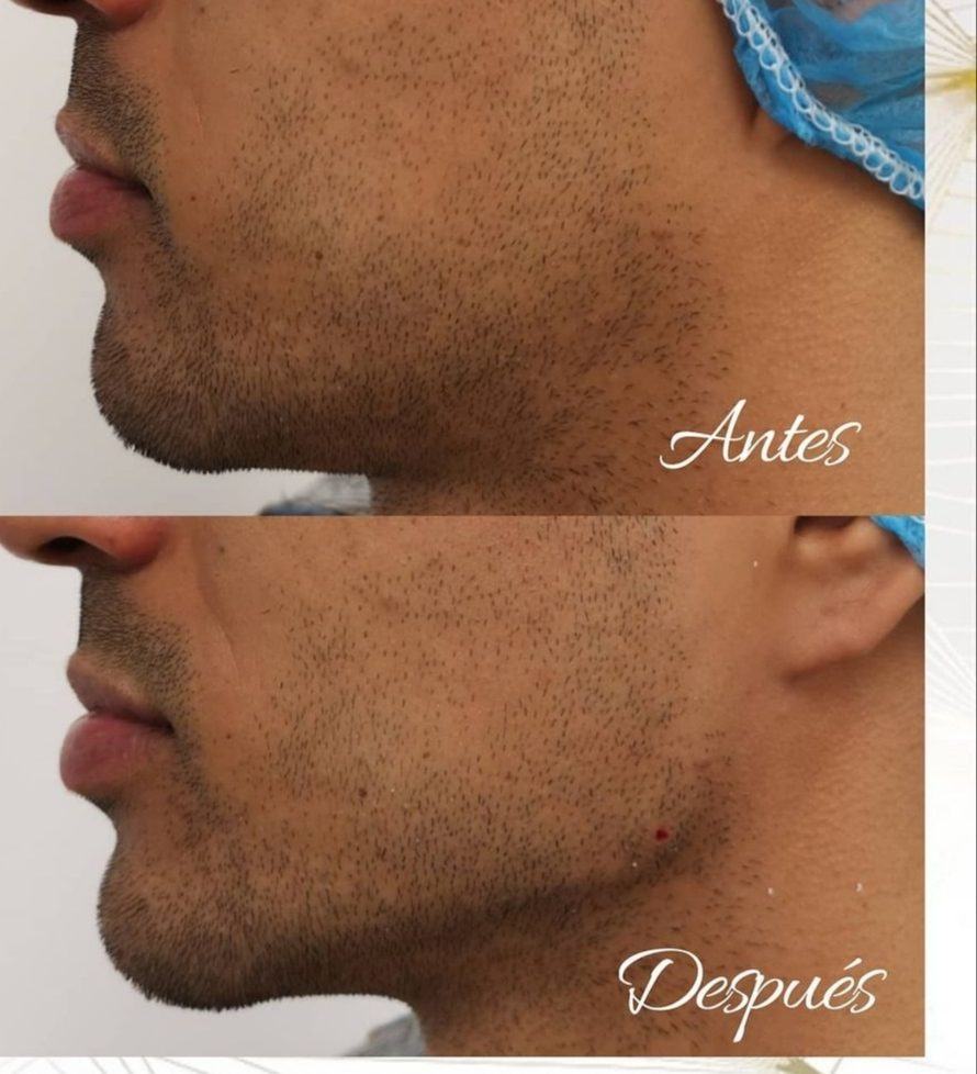 Resultados de perfil mandibular y mentón