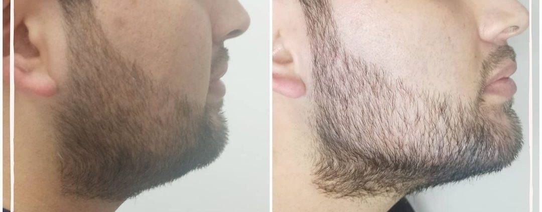 Perfil mandibular y mentón — fotografía clínica real