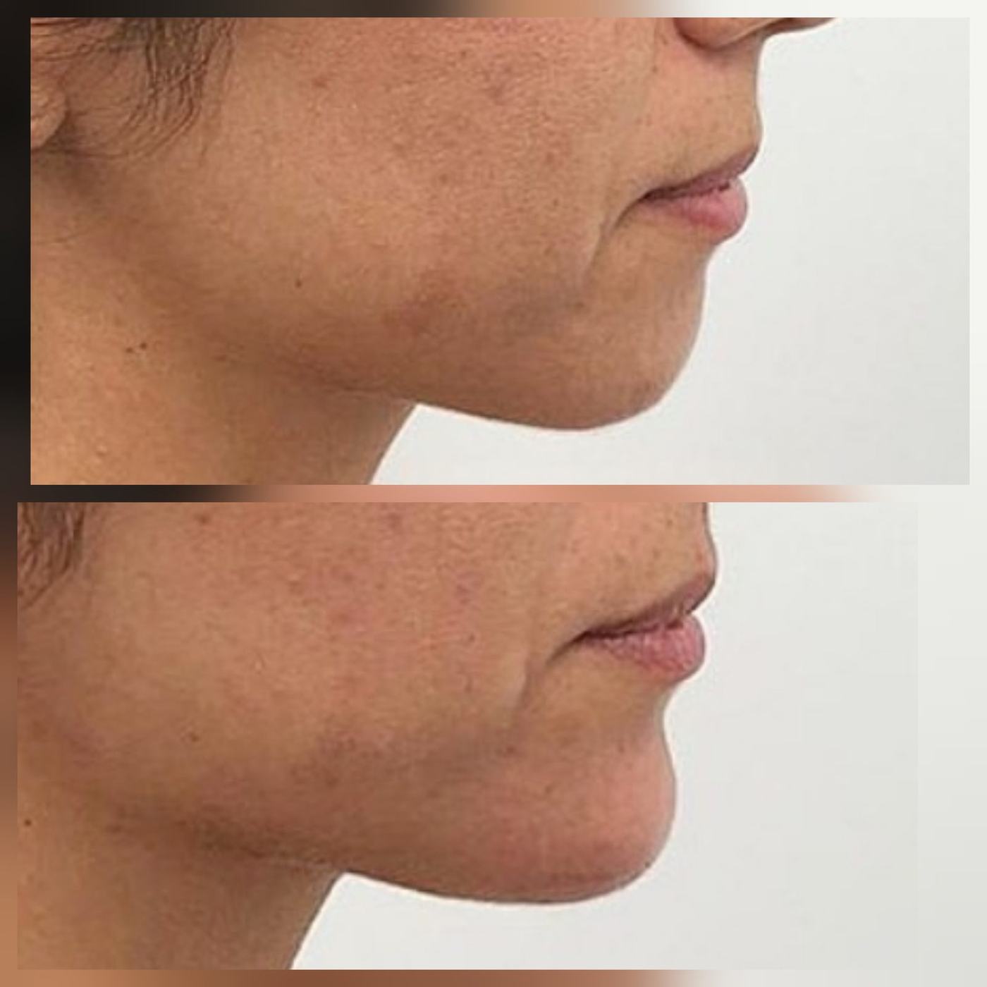Perfil mandibular y mentón — fotografía clínica real