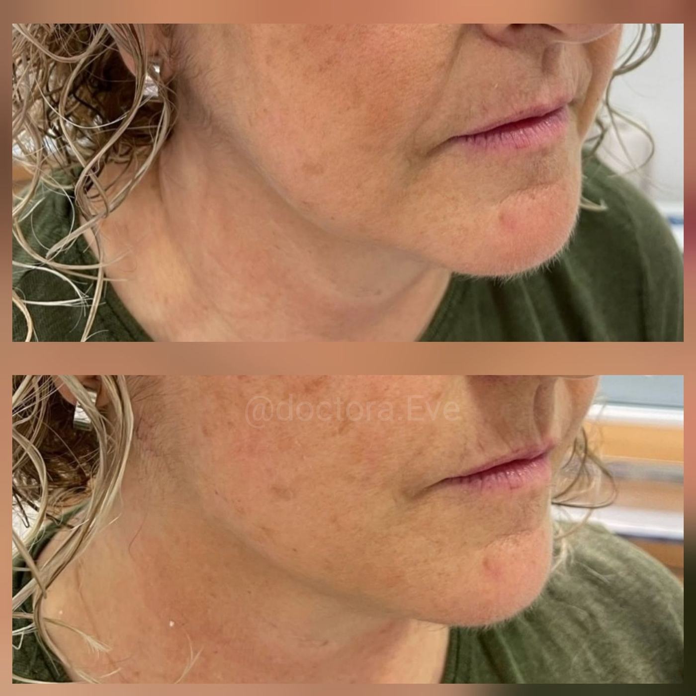 Perfil mandibular y mentón — fotografía clínica real