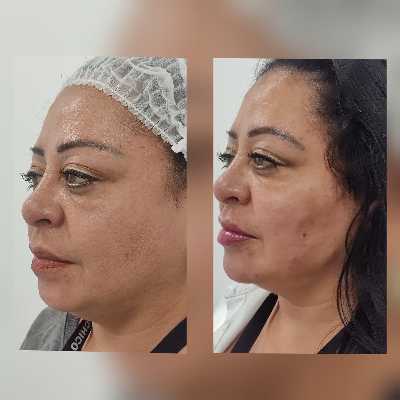 Perfil mandibular y mentón — fotografía clínica real