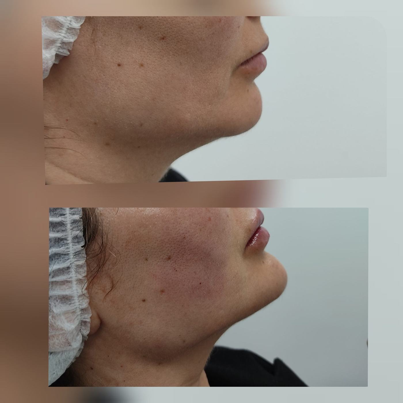 Perfil mandibular y mentón — fotografía clínica real