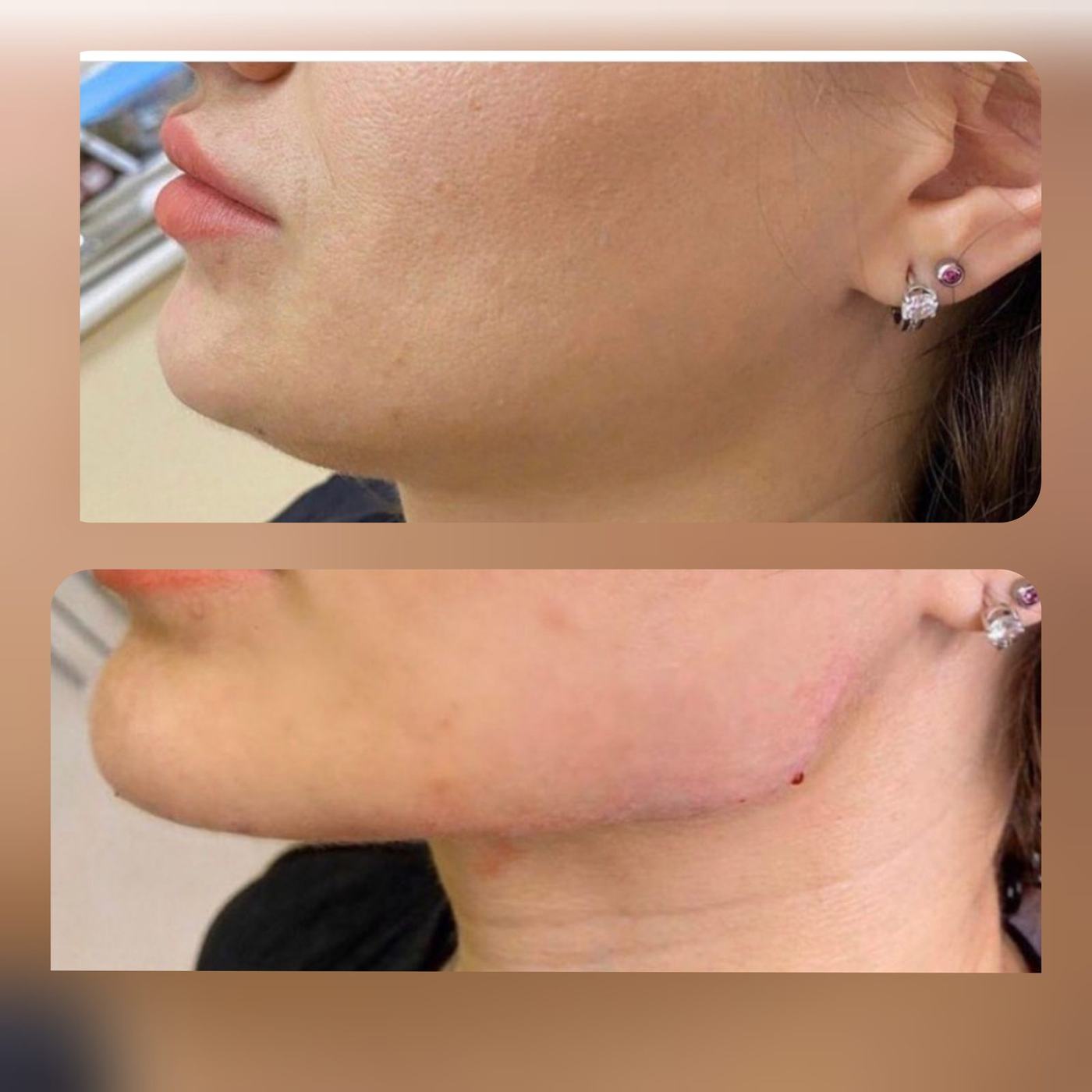 Perfil mandibular y mentón — fotografía clínica real