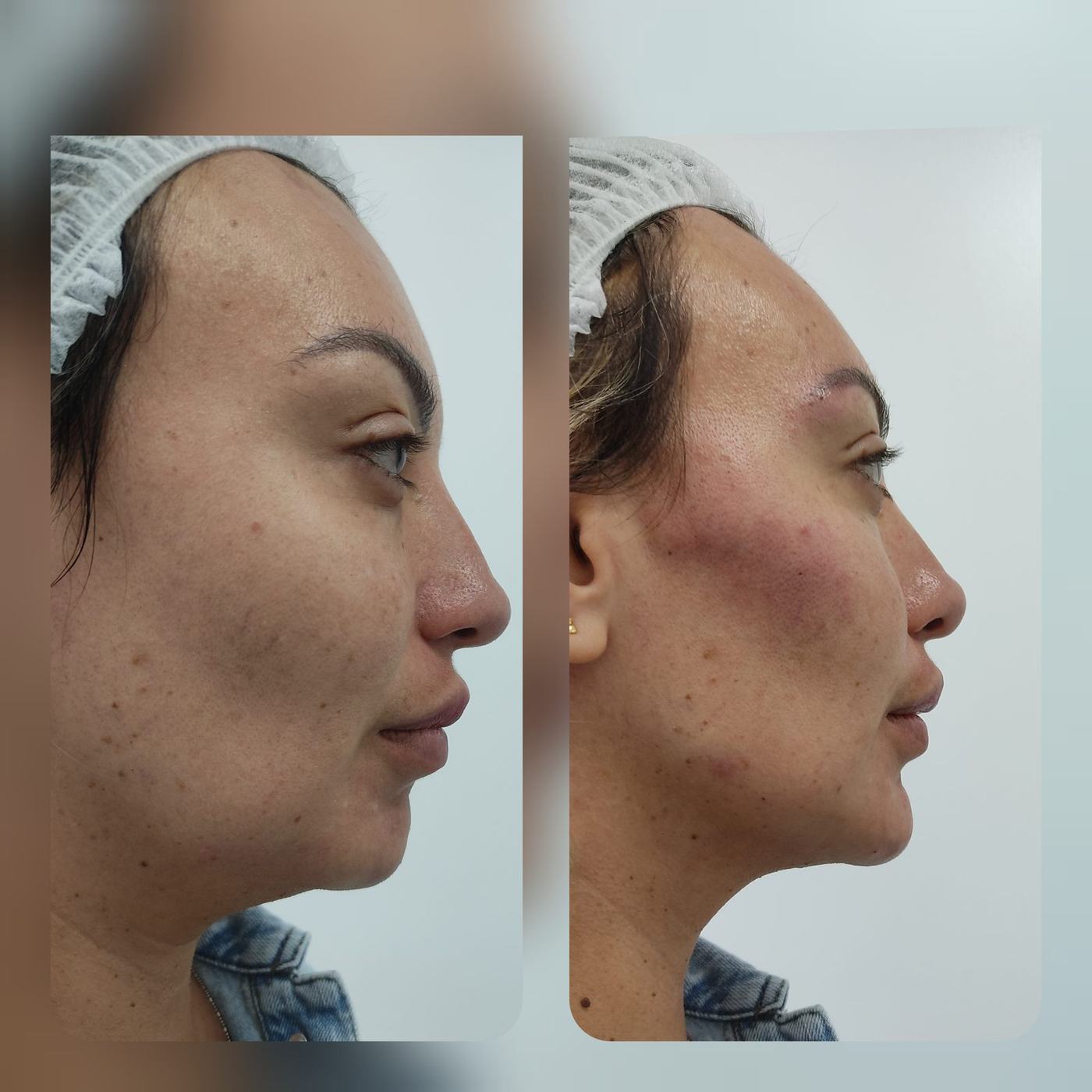 Perfil mandibular y mentón — fotografía clínica real