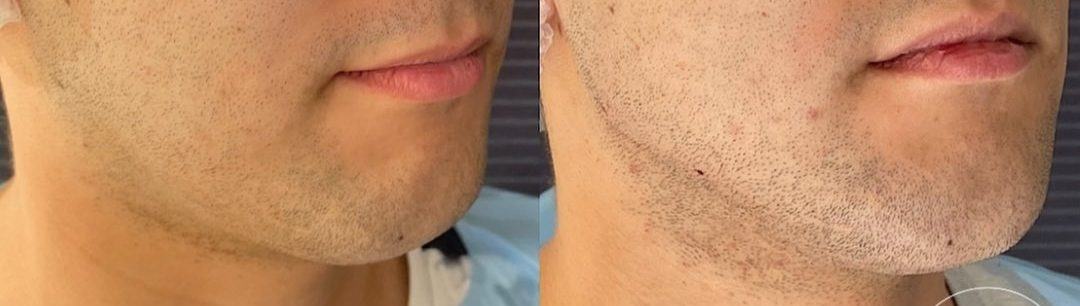 Perfil mandibular y mentón — fotografía clínica real