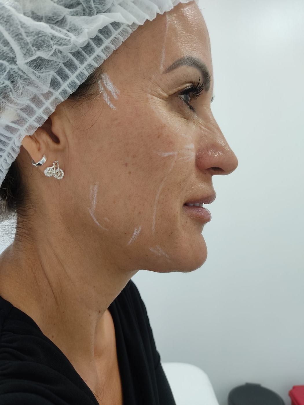 Perfil mandibular y mentón — fotografía clínica real