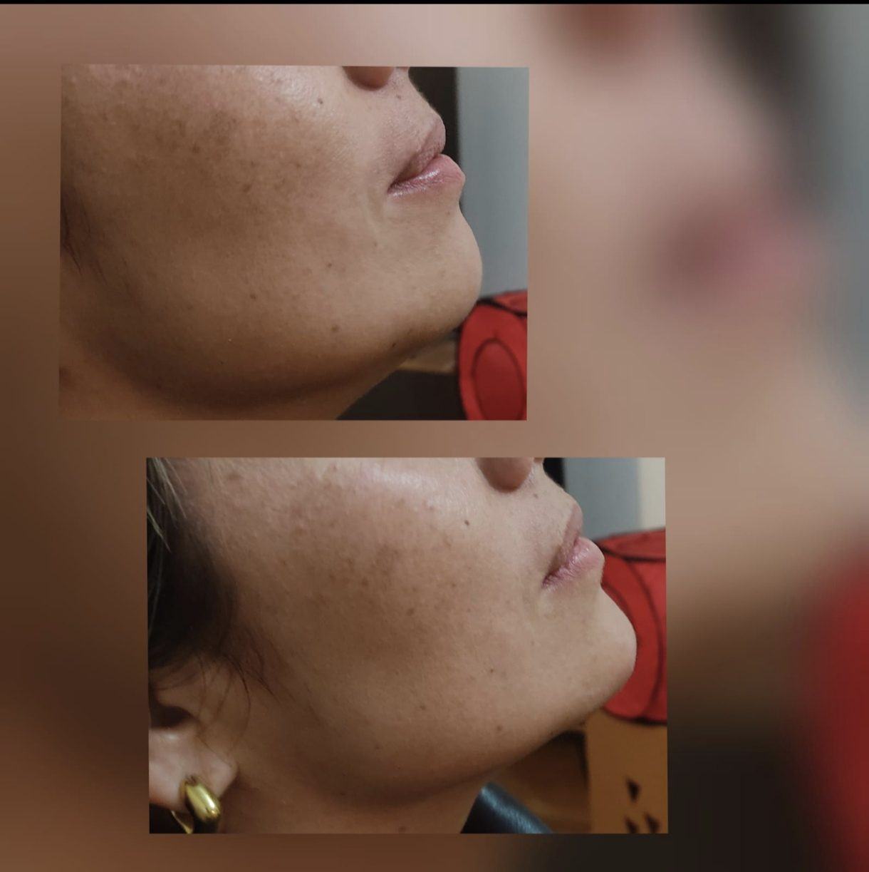 Perfil mandibular y mentón — fotografía clínica real
