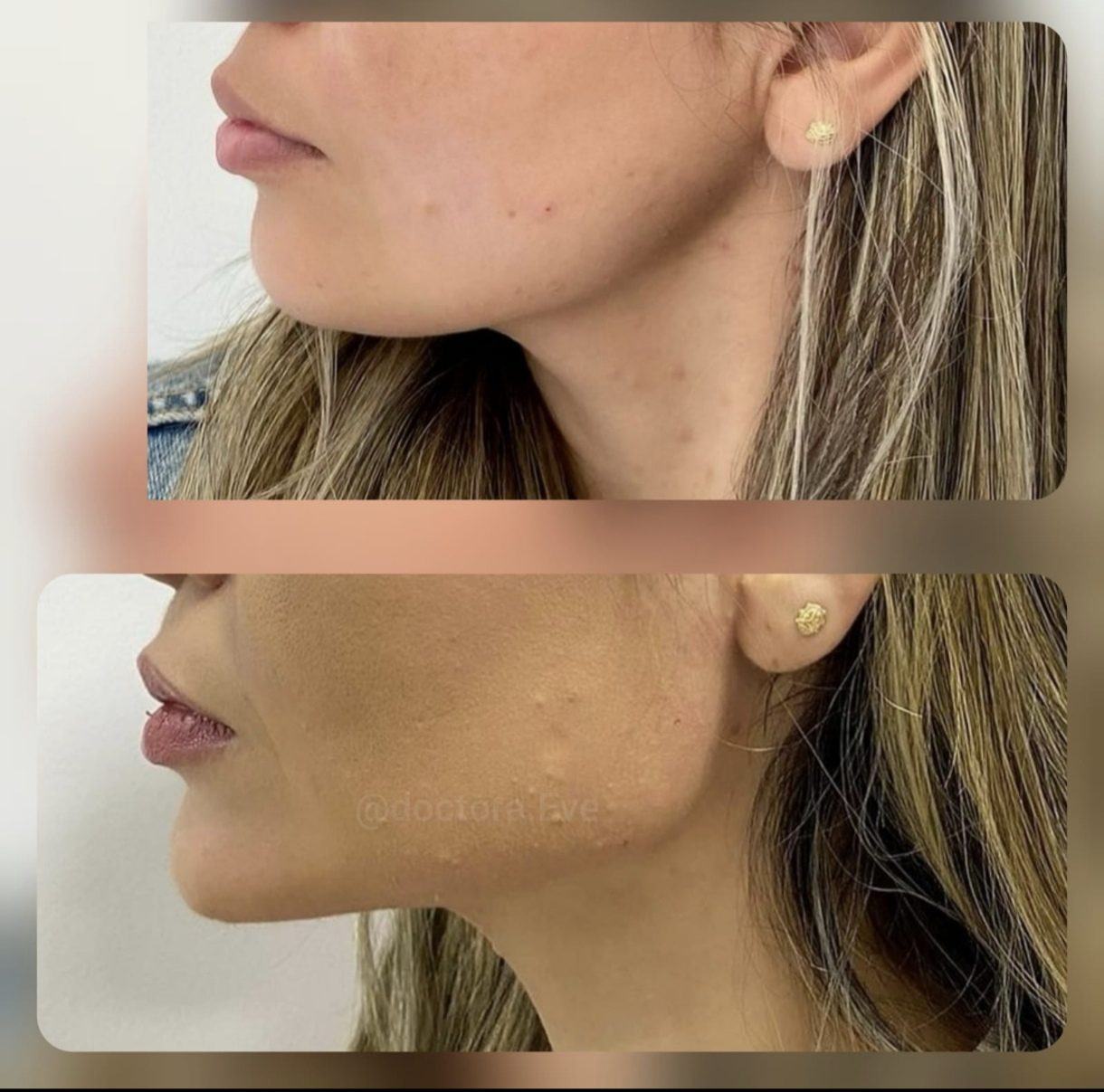 Perfil mandibular y mentón — fotografía clínica real